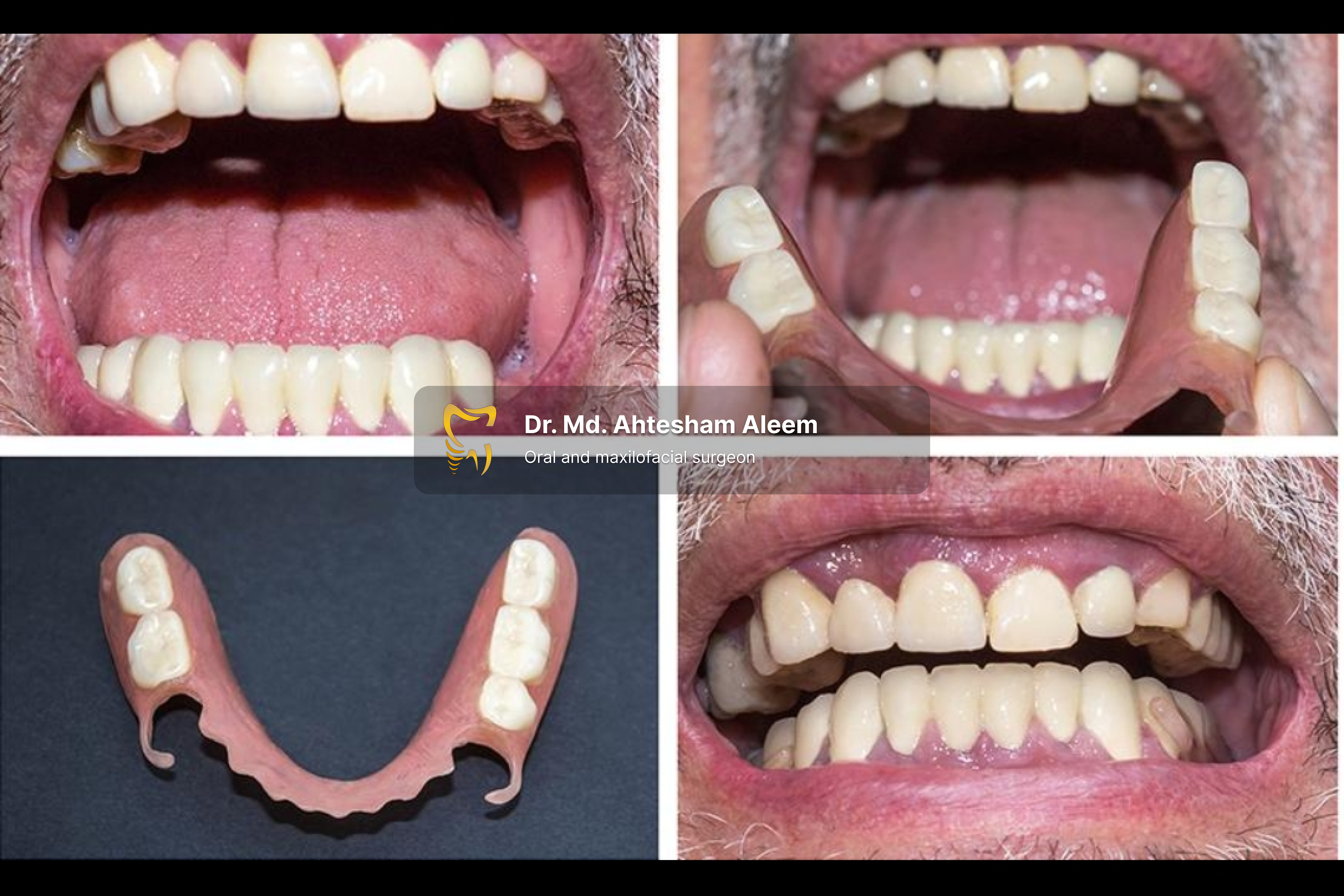 Flexible Dentures Image 1